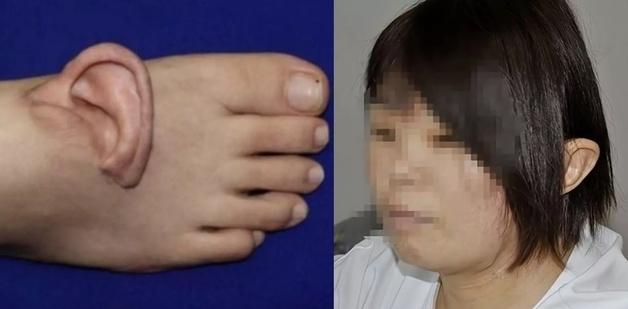 5개월간 발등에 귀 이식하고 다닌 여성…수술 끝낸 뒤 눈물 '펑펑'
