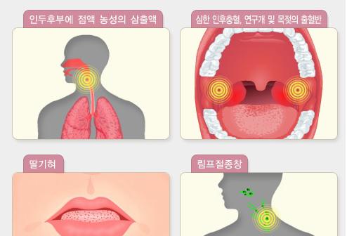 올해 성홍열 3809명 발생…청주·제주 소아시설 확산 주의(종합)